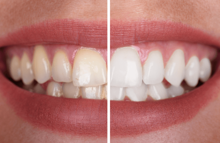 Before and after teeth whitening
