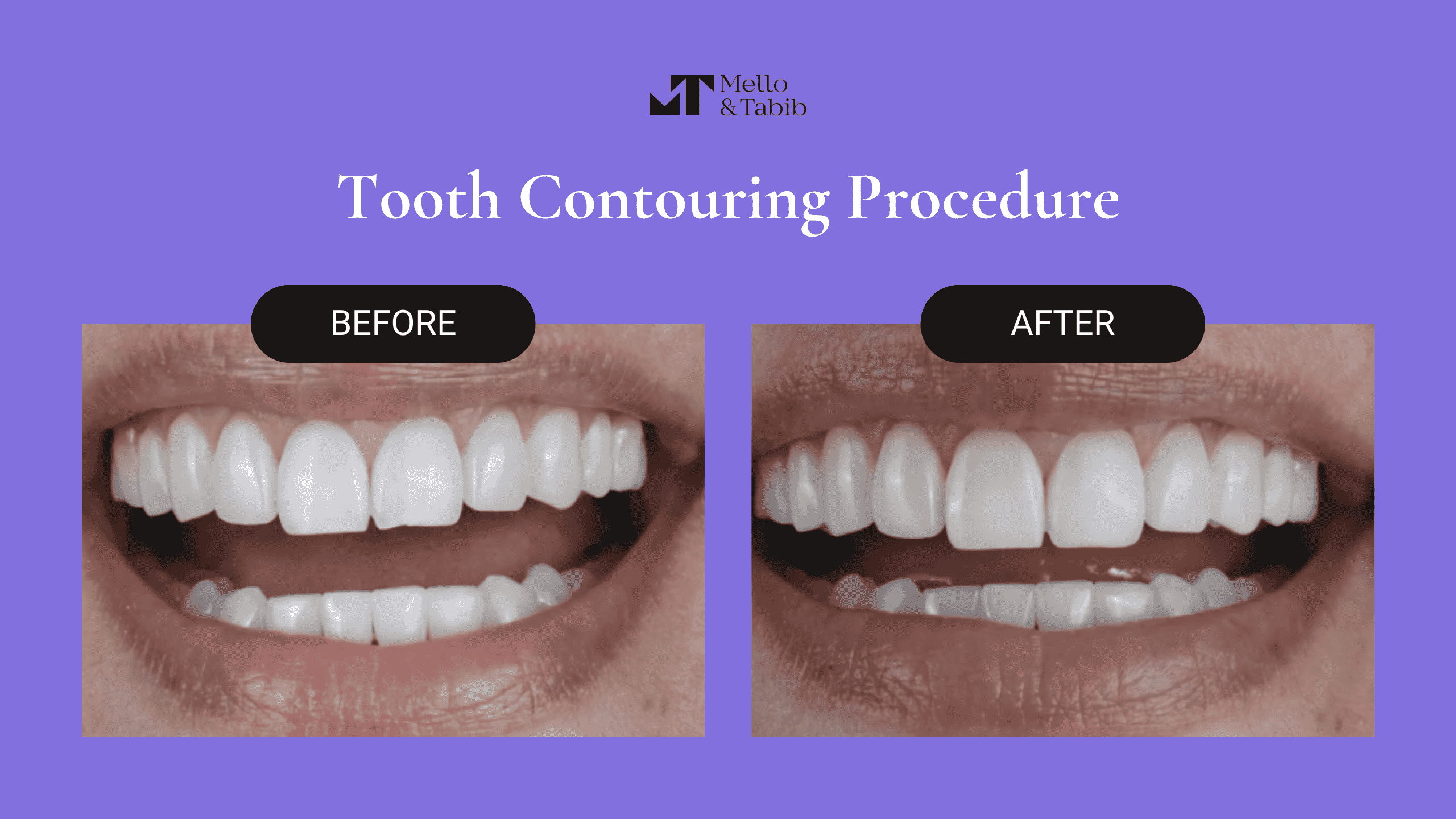 Does Tooth Contouring Hurt 2