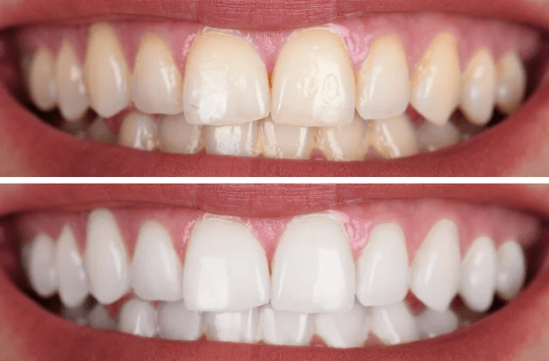 Before and after whitening