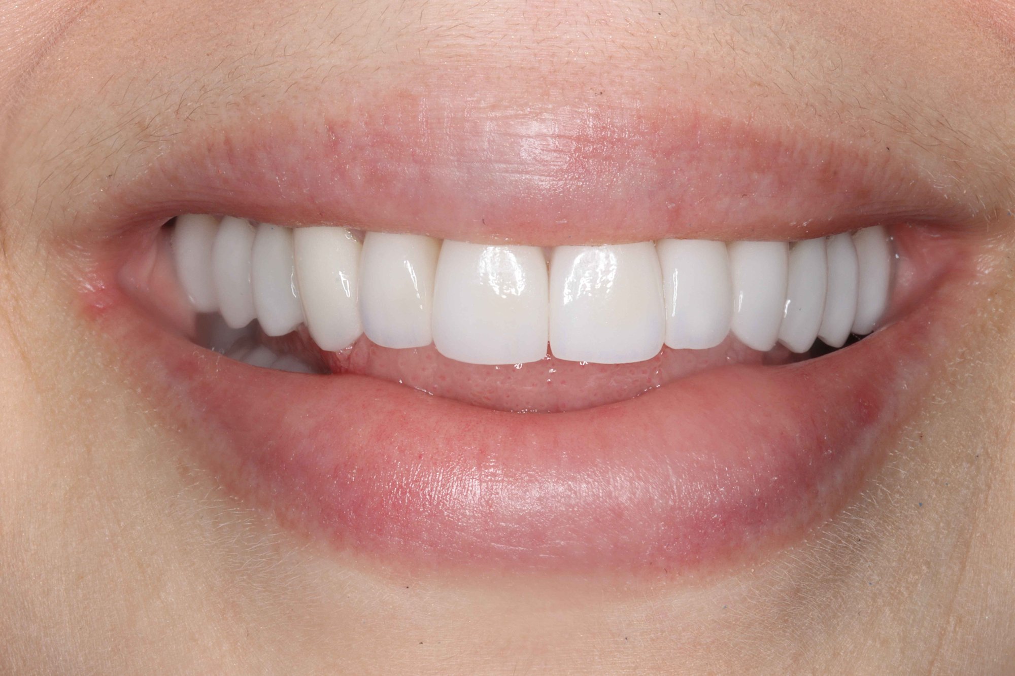 Close up of a veneer filled smile