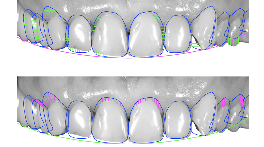 Can-I-Preview-My-Veneers-Before-They-Go-In-1