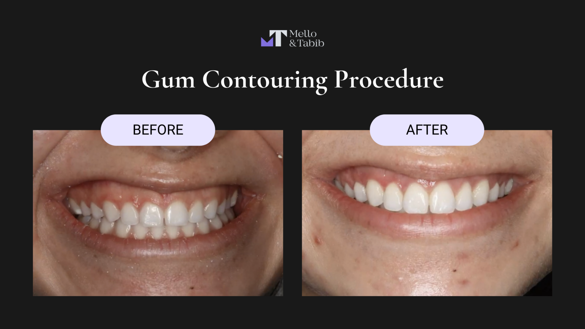 How-Long-Does-It-Take-Gum-Contouring-To-Heal-4-1920x1080