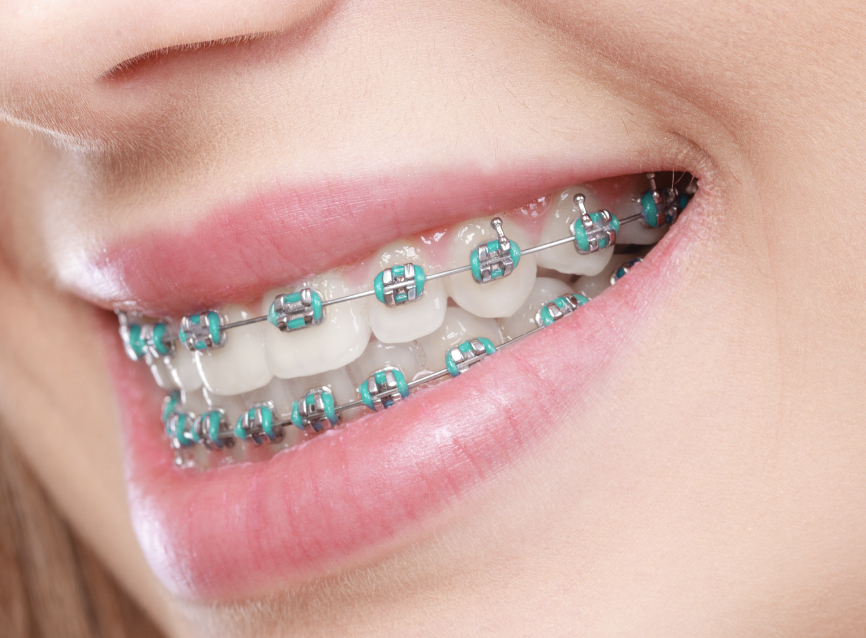 Is-Invisalign-Better-Than-Traditional-Braces-2