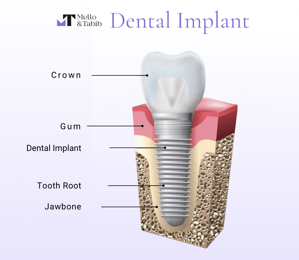 Dental Implant Diagram