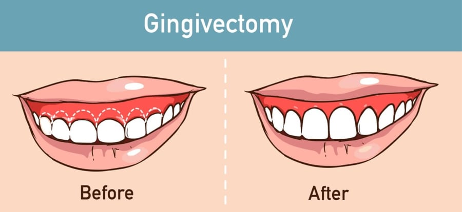 Gingivectomy Diagram