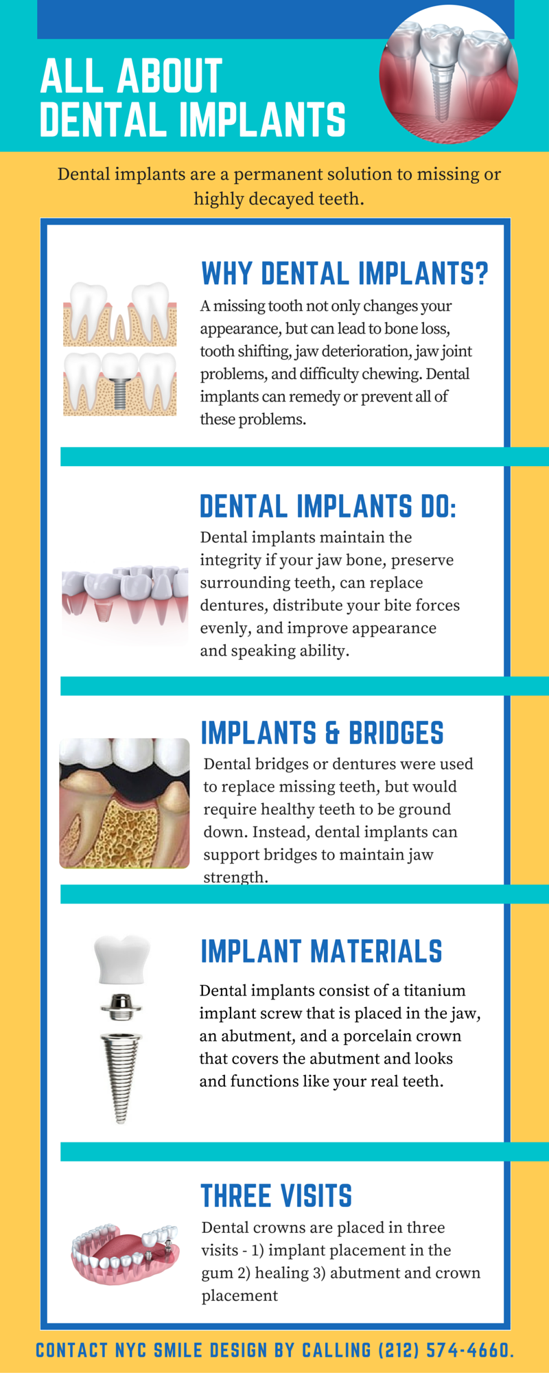 Infographic - All About Dental Implants | NY Dentist