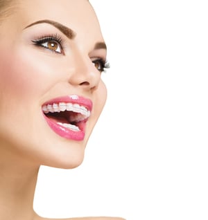 New York City Ceramic Braces | Tooth Colored Braces Manhattan