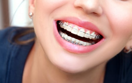 Close up of girl wearing ceramic braces