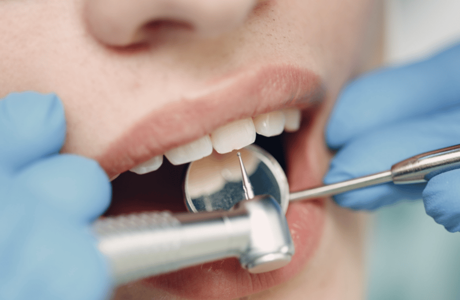 Teeth Contouring Procedure