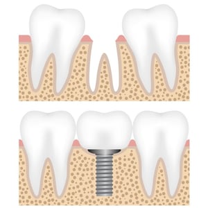 Dental implants can last a lifetime. To learn more, call 212-452-3344 and schedule a consultation with our NYC implant dentists today.