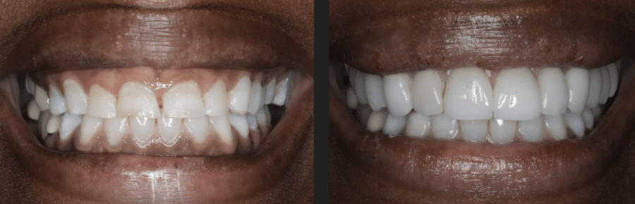 Before and After Gum Contouring
