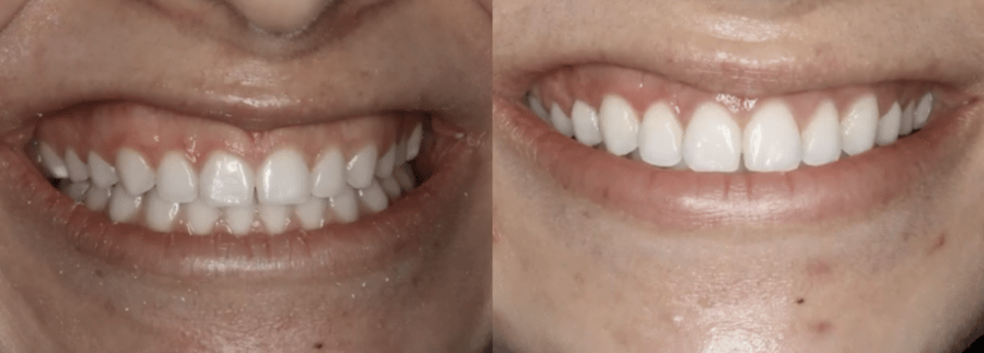 Before and after gum lift