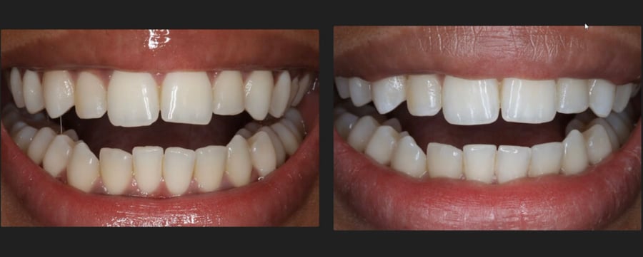 Before and after