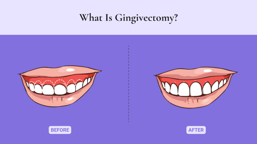 What is Gingivectomy?