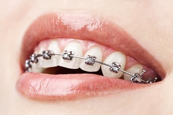 Clsoeup of woman smiling with braces