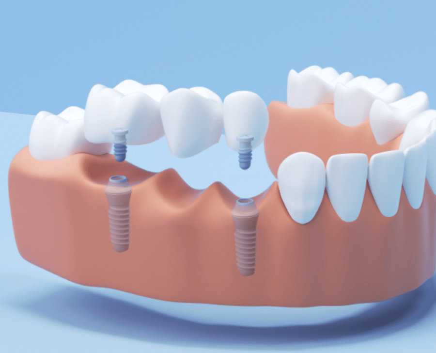 Dental Implant