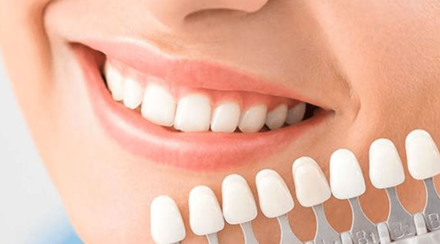 Choosing Veneers
