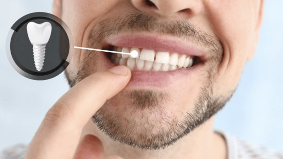Dental Implants
