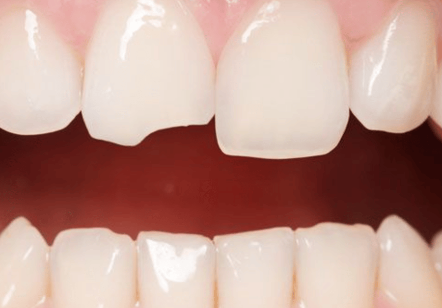 Chipped tooth