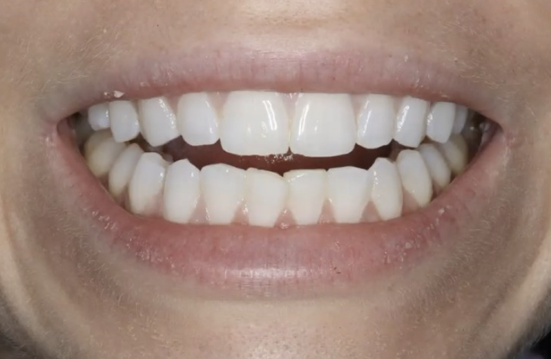 non-contoured teeth