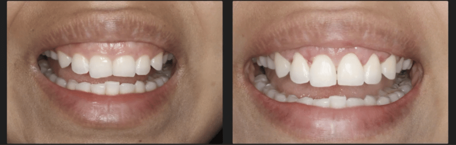 Before and After Uneven Gums