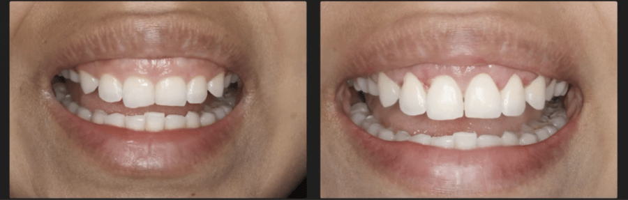 Before and After Uneven Gums