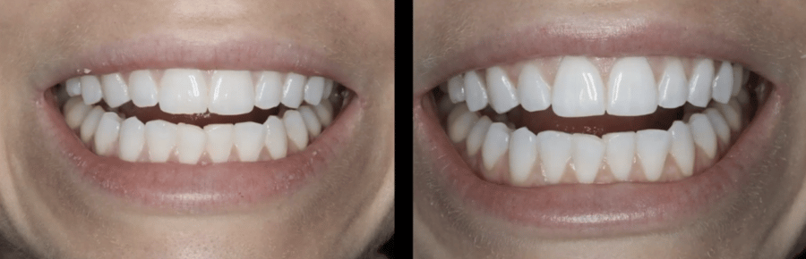 Before and after tooth contouring