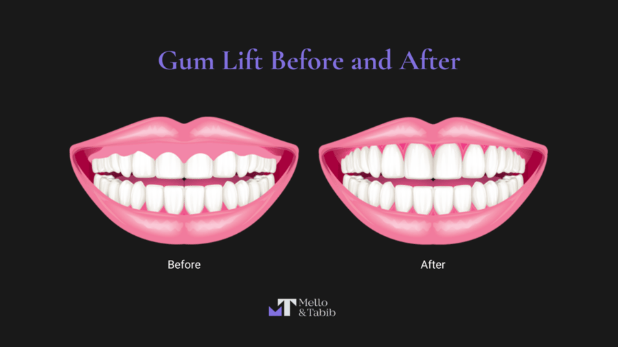 Before and After Gum Removal
