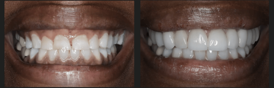 Before and after gun removal