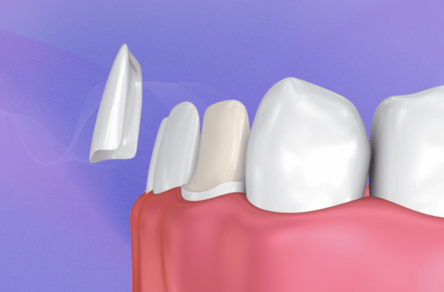 How to adhere veneers