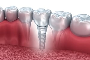 dental implants nyc smile design manhattan new york cosmetic dentist