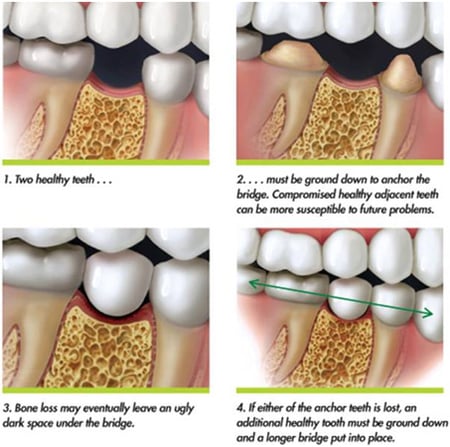 Dental Implants vs. Dental Bridges | Manhattan