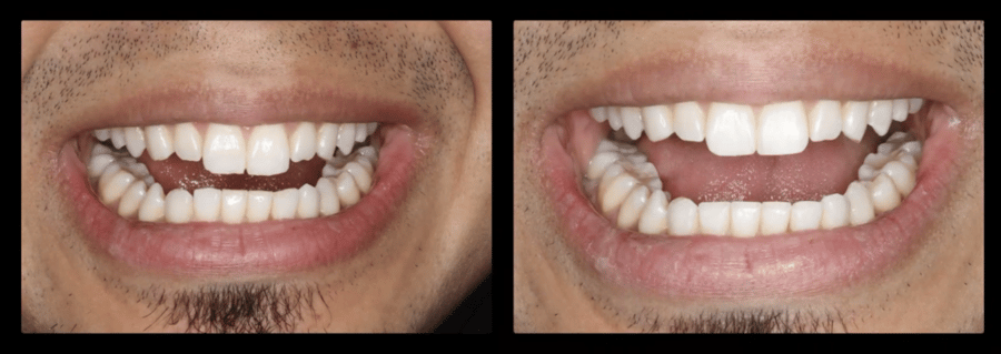 Before and after tooth contouring
