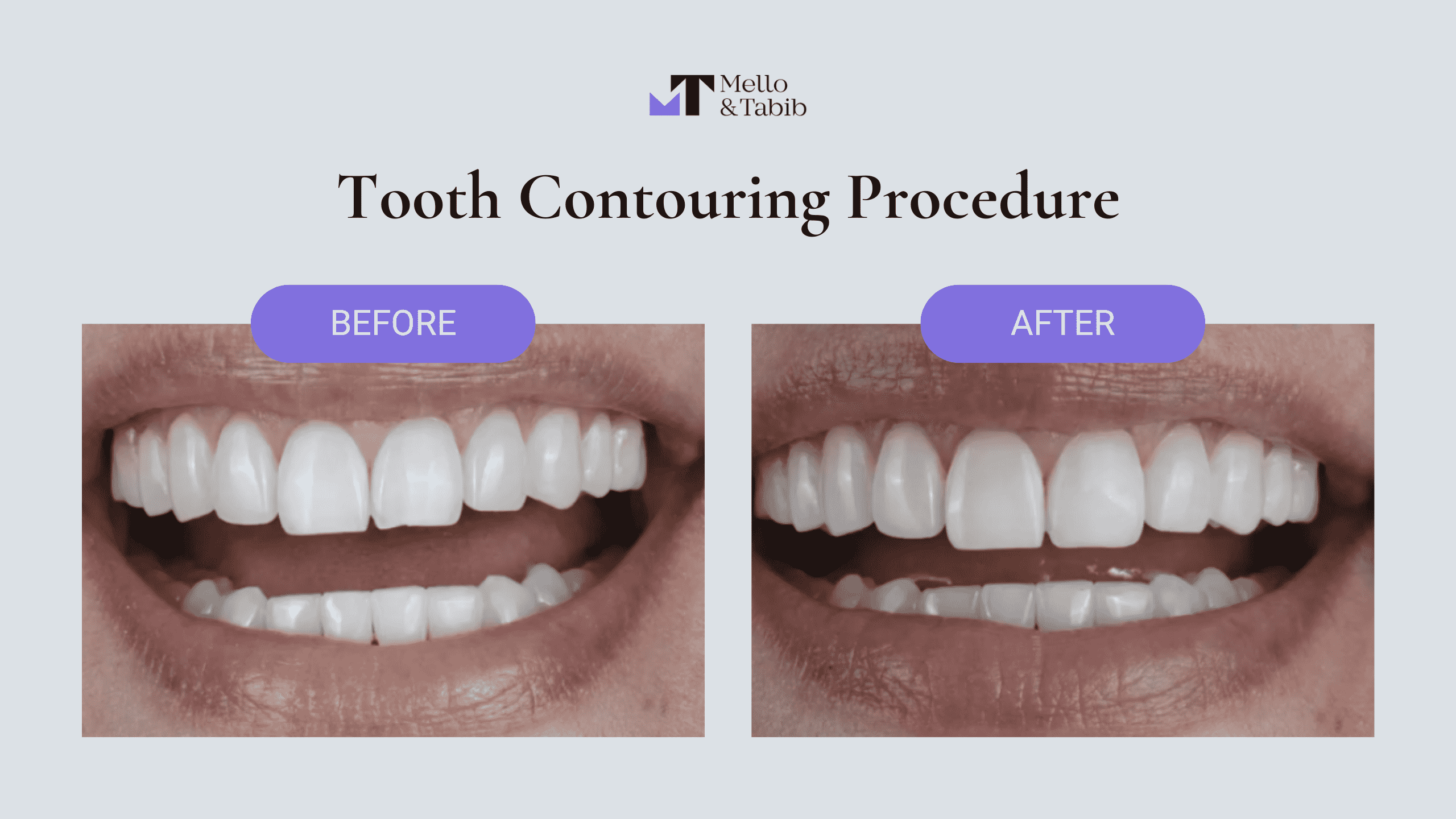 Before and After Tooth Contouring 