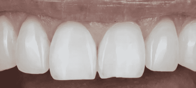 A person who may get tooth contouring 