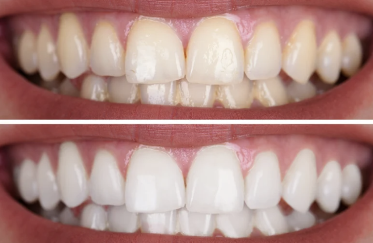 Whitening Teeth