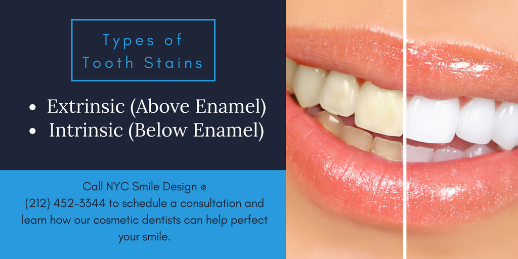 Types of Tooth Stains