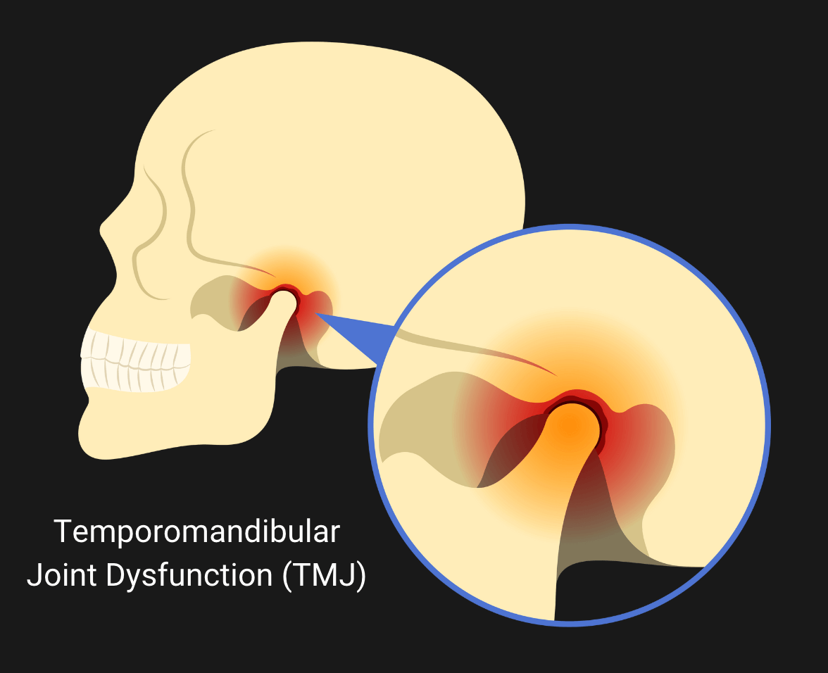 A Diagram of TMJ