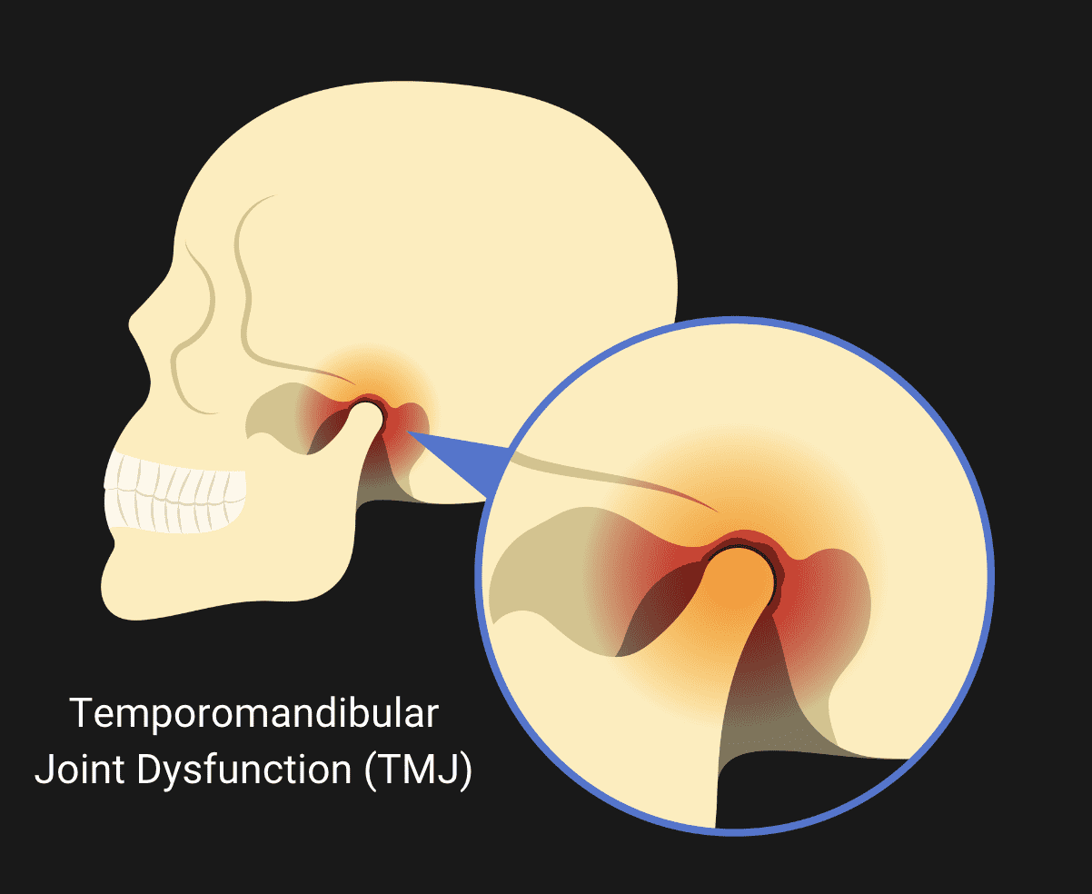 A diagram of the Temporomandibular Joint
