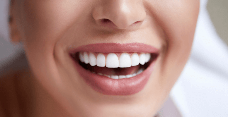 Women Smiling with White Teeth