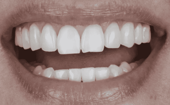 Before a tooth contouring procedure 
