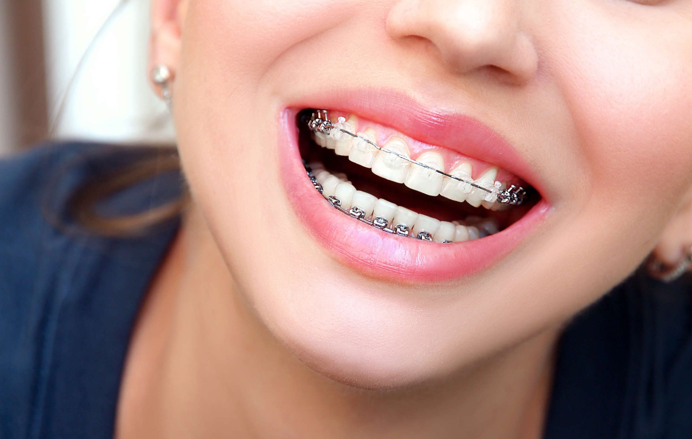 Questions About Ceramic Braces | NYC Smile Design | Manhattan, New York